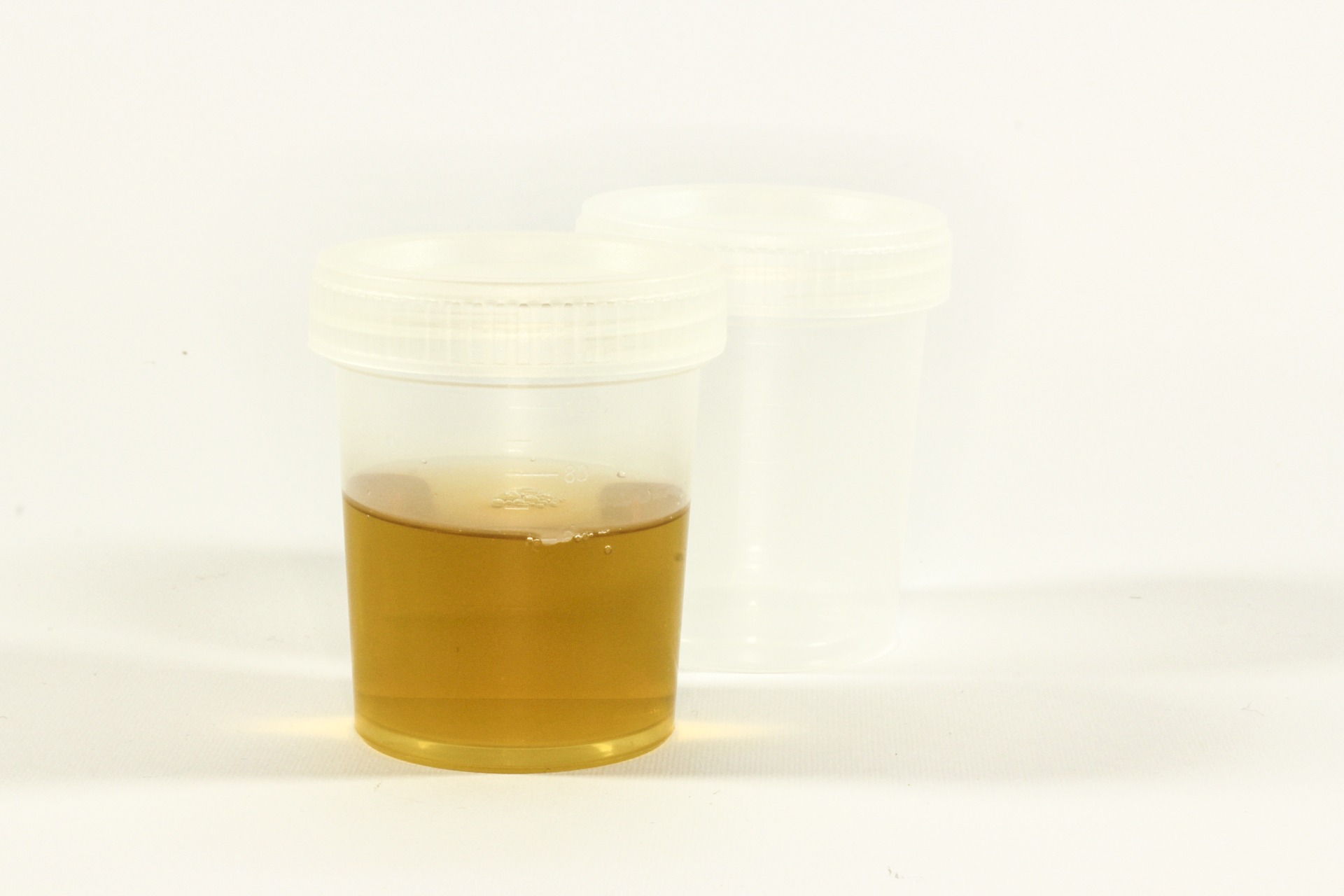 Becher mit Urin, Harn, Natursekt: Möchte man das trinken?