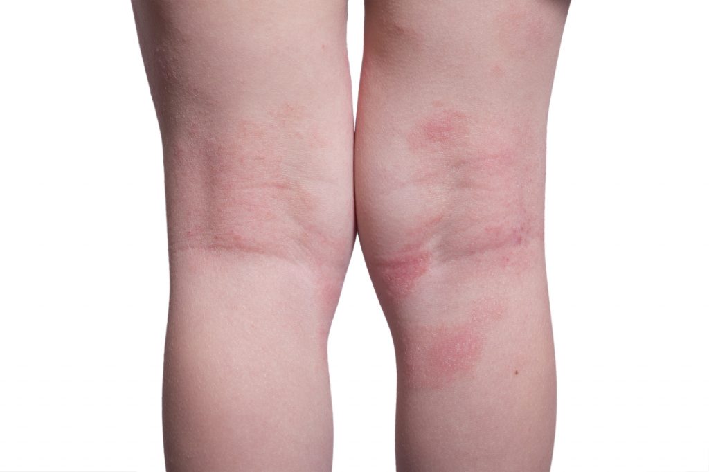 Ihre zarte Haut bekommt einen Ausschlag oder eine Allergie, wenn ich sie dort küsse!