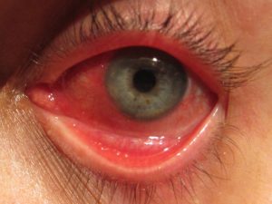 Bindehautentzündung (Konjunktivitis), Entzündung Auge durch Sperma