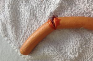 Penisbruch durch zu hartes Onanieren