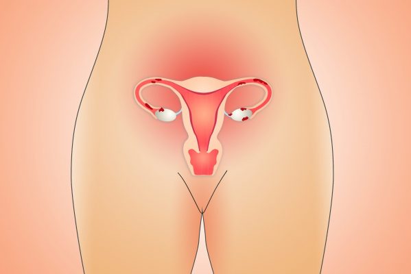 Endometriose kann große Schmerzen beim Sex verursachen