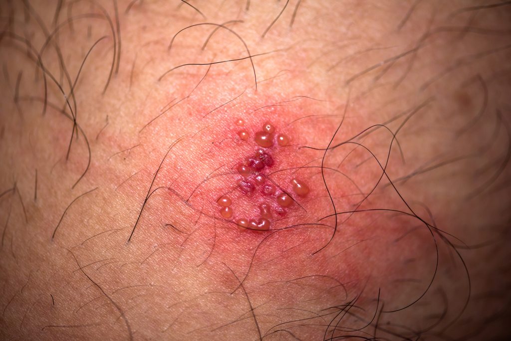Wie ansteckend ist Herpes (Genitalherpes)?