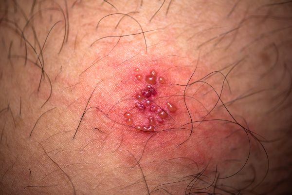 Gefahr der Ansteckung durch Herpes-Bläschen?